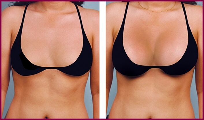 avant et après augmentation mammaire graisseuse