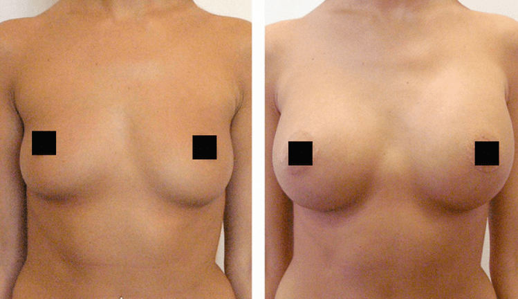 seins avant et après augmentation de l'acide hyaluronique