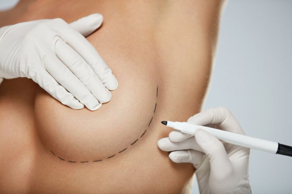 mammoplastie périaréolaire du sein