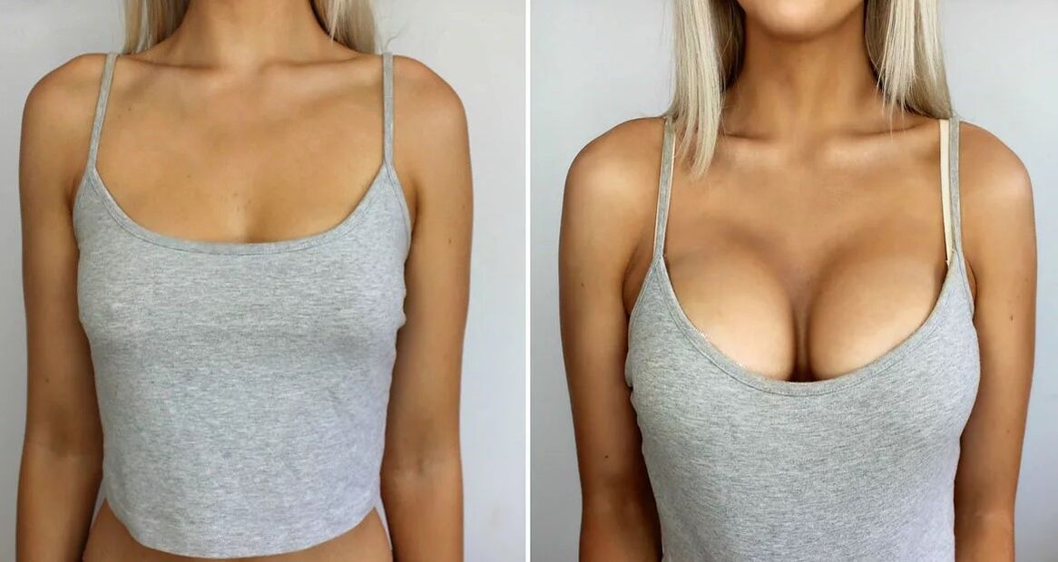Augmentation du sein 3 taille