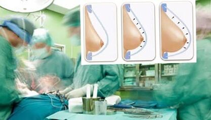 Comment le lipilifting sinusoïdal est effectué