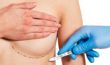Accès sous-dynamique à l'élargissement du sein avec les implants