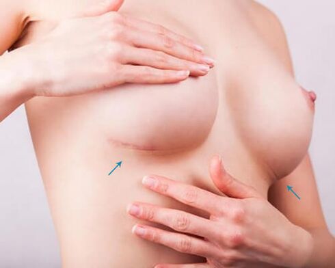 Expansion mammaire avec implants
