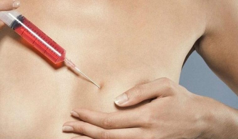 Augmentation mammaire par injections d'acide hyaluronique