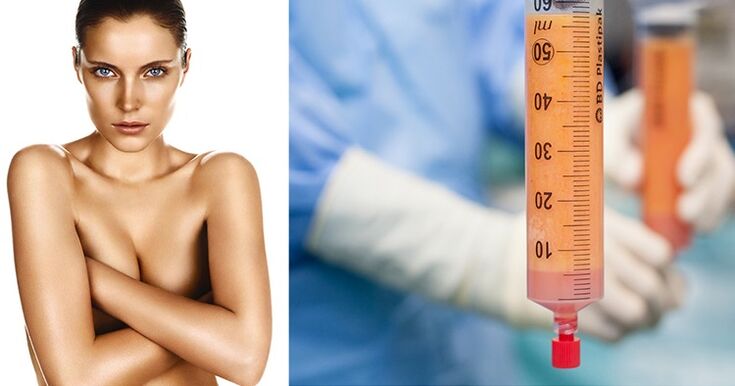 le lipofilling comme méthode d'augmentation mammaire